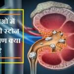 किडनी स्टोन के लक्षण