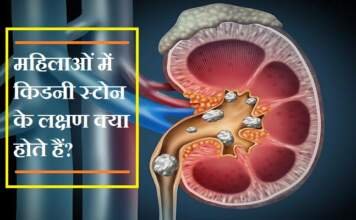 किडनी स्टोन के लक्षण
